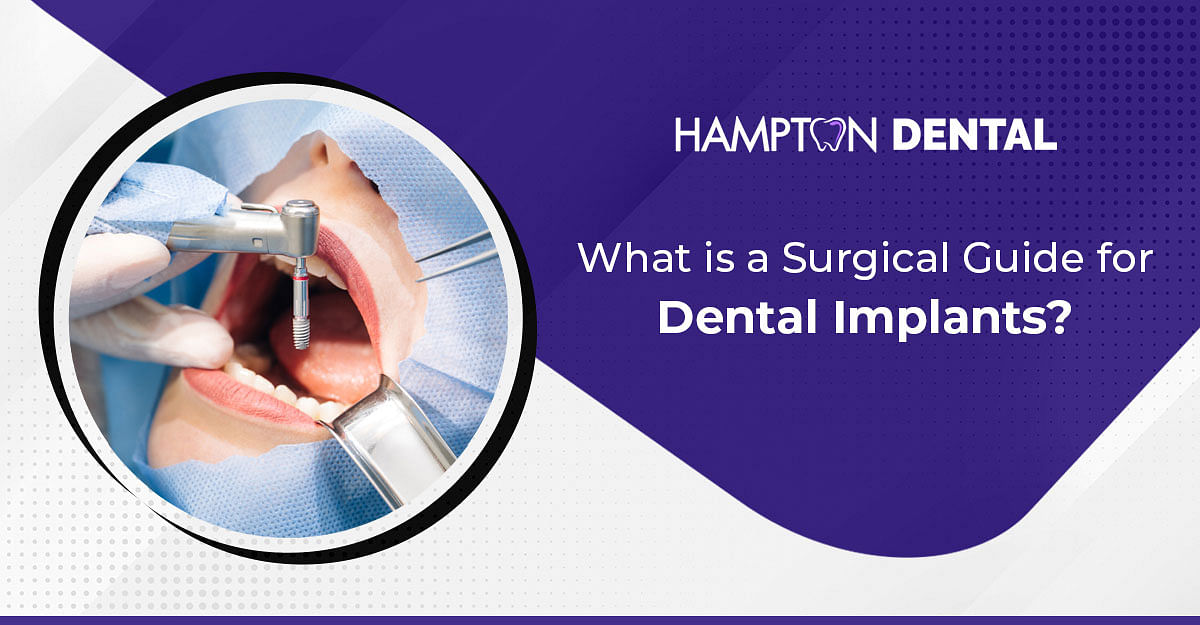 The Importance of Surgical Guides for Dental Implants